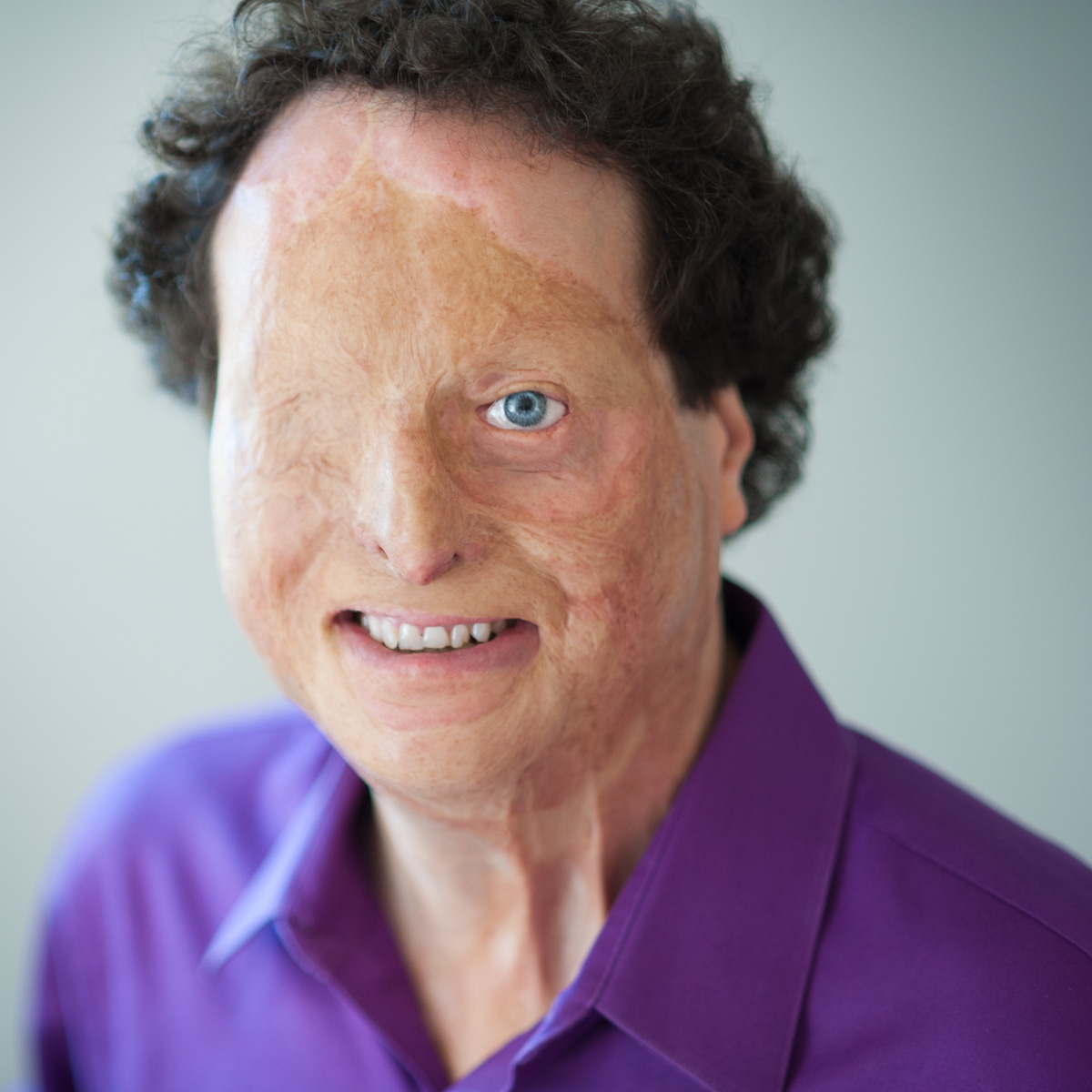 A smiling man with curly dark hair and facial-burn scars wearing a purple collared shirt.